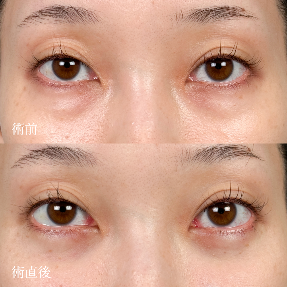 切らないクマ取りの術直前・直後比較