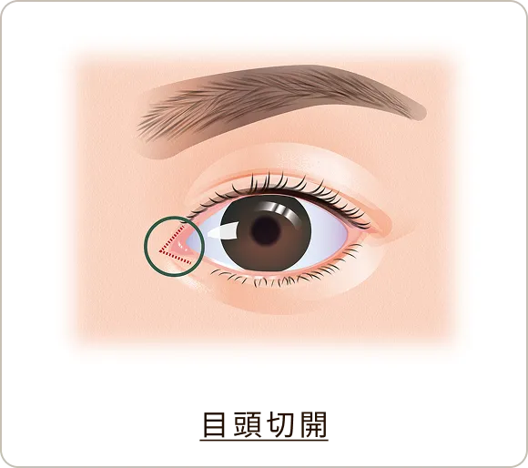 目頭切開